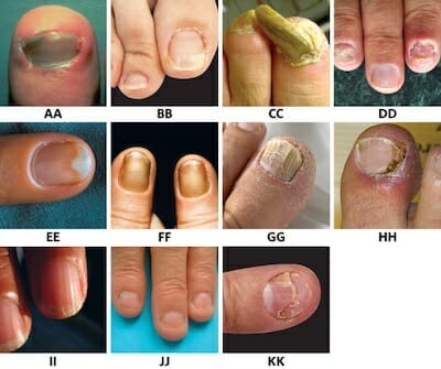 Finger Nail Plate Damage - Lunula Can Reverse Damage. - Compleet Feet