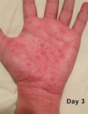 Scabies-spread and control concept of psora and homeopathic approach